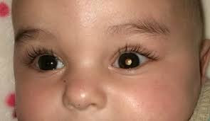 Retinoblastoma